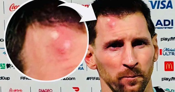 Messi sưng vêu trán sau trận thắng Cabo Verde: Vì sao nên nỗi? - hình ảnh - vn-new88.com